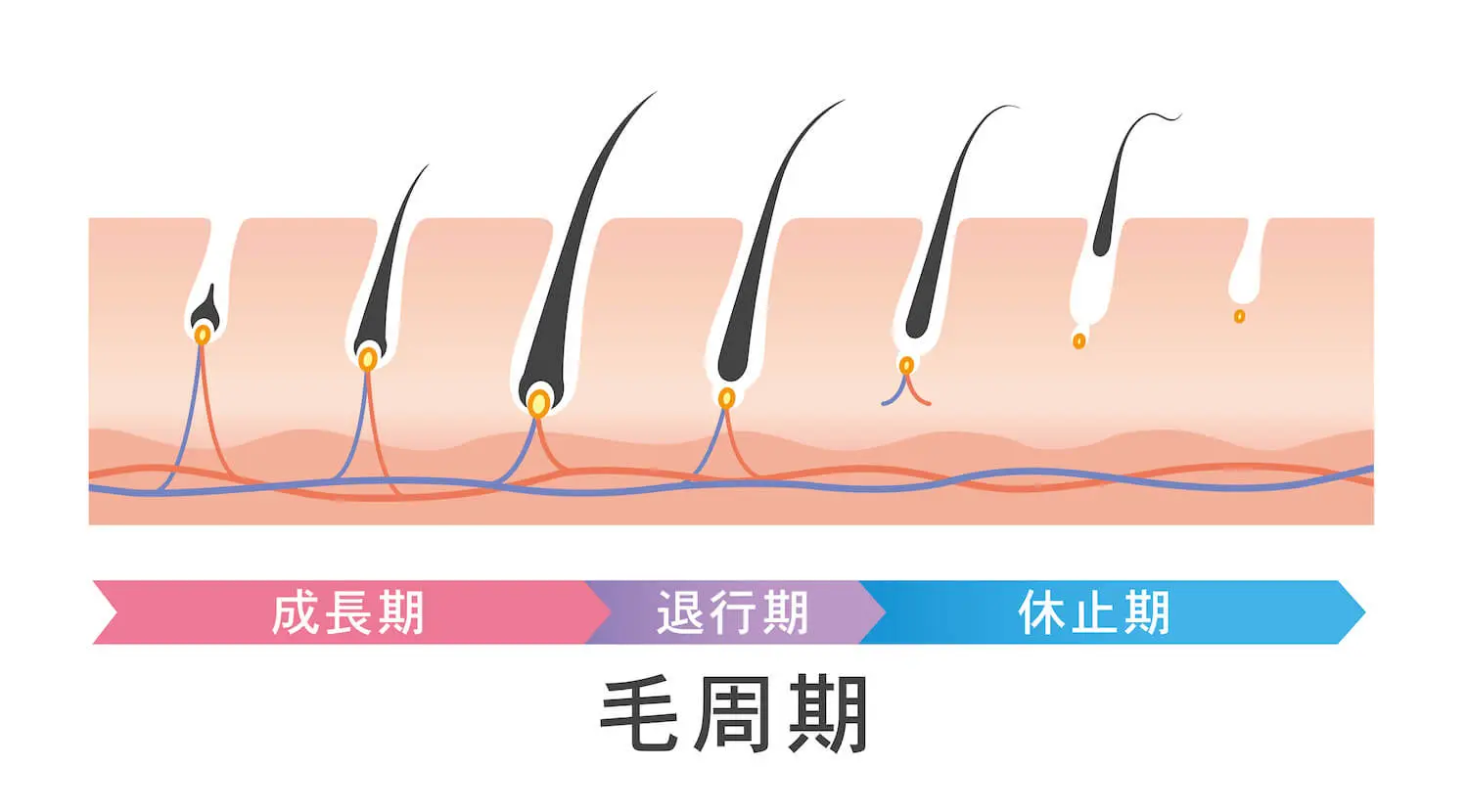 レーザー脱毛のメカニズム図解