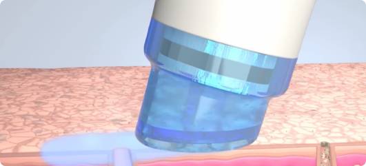 毛穴の洗浄と皮膚の軟化